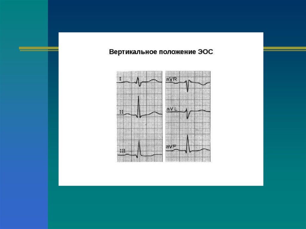 Экг вертикальное. Электрическая ось вертикальная ЭКГ. Вертикальное положение электрической оси сердца на ЭКГ. ЭОС вертикальная на ЭКГ что это. Вертикальное положение электрической оси.