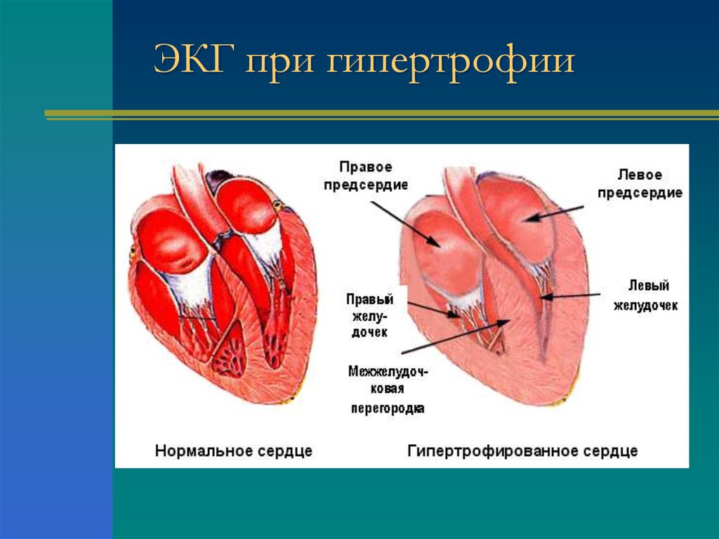 Глж сердца. Гипертрофия миокарда предсердий. Гипертрофия отделов сердца. Гипертрофия левого желудочка и предсердия сердца. Гипертрофия левого предсердия и правого желудочка.