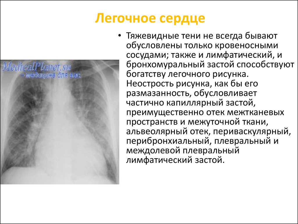 Легочное сердце картинки