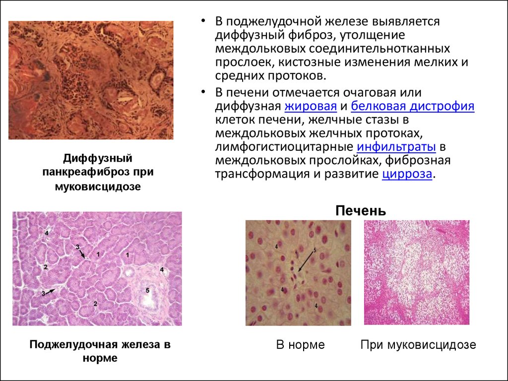 Ткани печени. Поджелудочная железа при муковисцидозе микропрепарат. Муковисцидоз поджелудочной железы микропрепараты. Фиброз поджелудочной железы гистология. Муковисцидоз патанатомия.