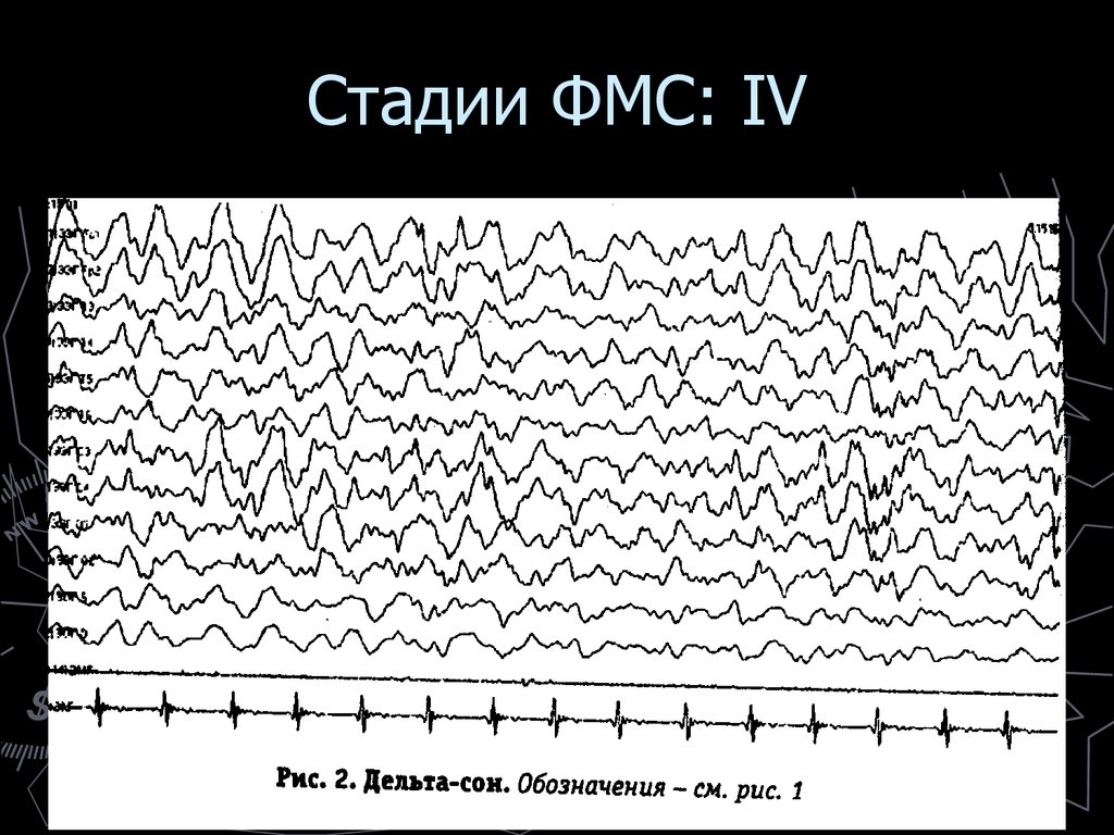 Дельта волны. Фаза Дельта сна. Дельта волны для сна. Дельта волны стадии сна. Дельта ритм сна.