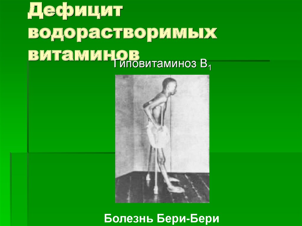 Бери бери это. Болезнь бери-бери ( дефицит витамина в1). Недостаток витамина в1 бери бери. Авитаминоз витамина в1 болезнь бери бери. Болезнь бери бери симптомы.