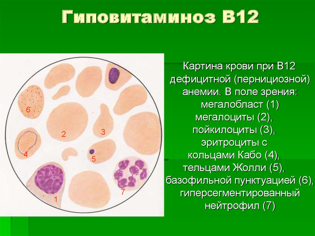 Картина крови при в12 дефицитной анемии периферической