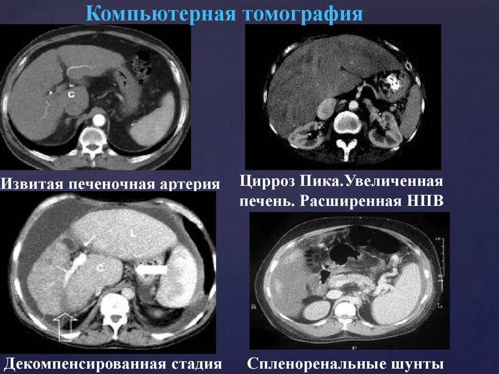 Можно ли кт. Портальная гипертензия в печени на кт. Билиарный цирроз печени кт. Компьютерная томография кт цирроз печени. Магнитно-резонансная томография печени цирроз.