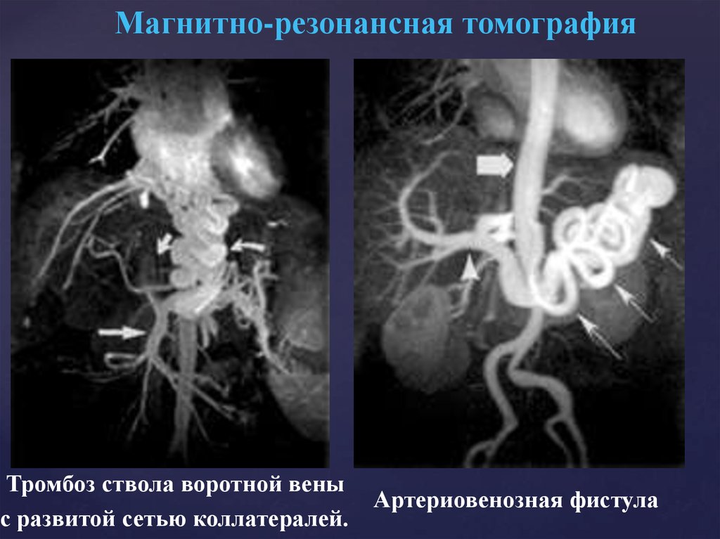 Тромбоз воротной вены печени. Коллатерали воротной вены. Кавернозная трансформация воротной вены кт. Воротная Вена печени кт. Тромбоз портальной вены кт.