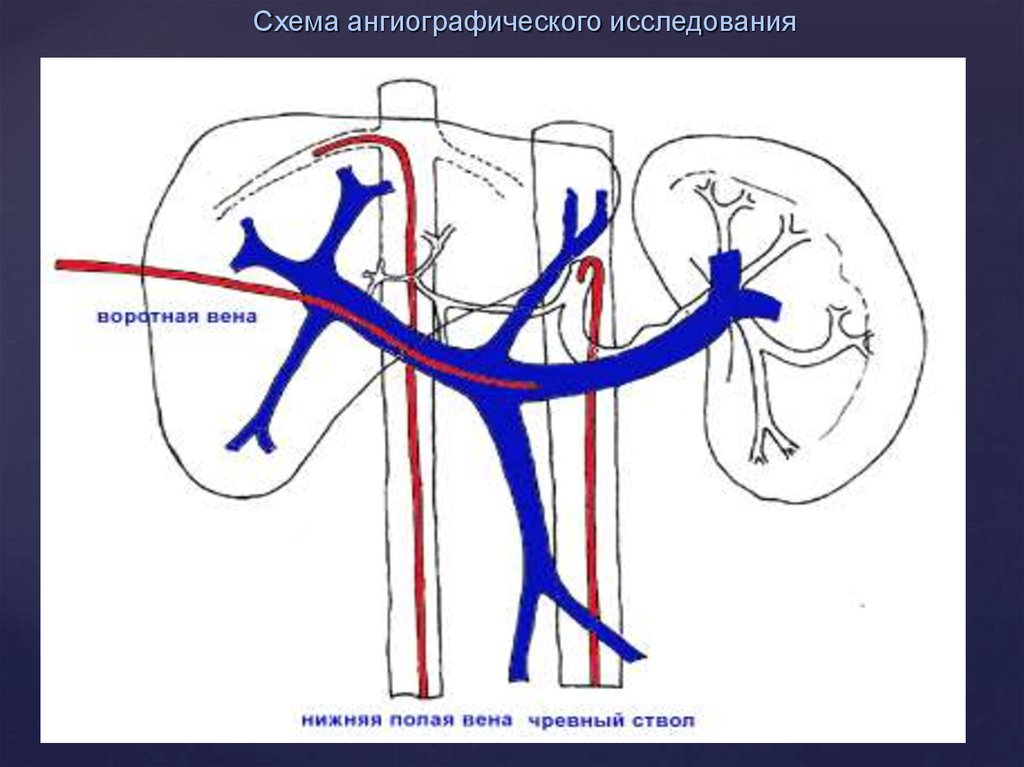 Нижняя полая вена образуется. Система воротной вены схема. Схема нижней полой вены. Нижняя полая Вена схема. Система нижней полой вены анатомия.
