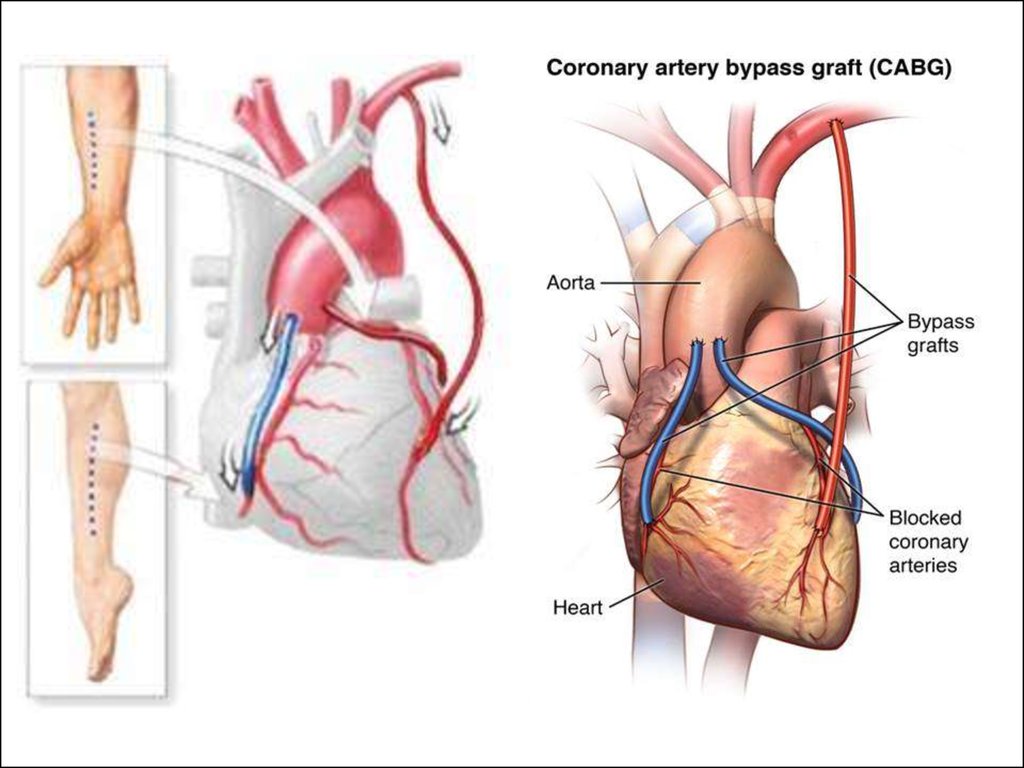 Шунтирование сердца. Аортокоронарное шунтирование презентация.