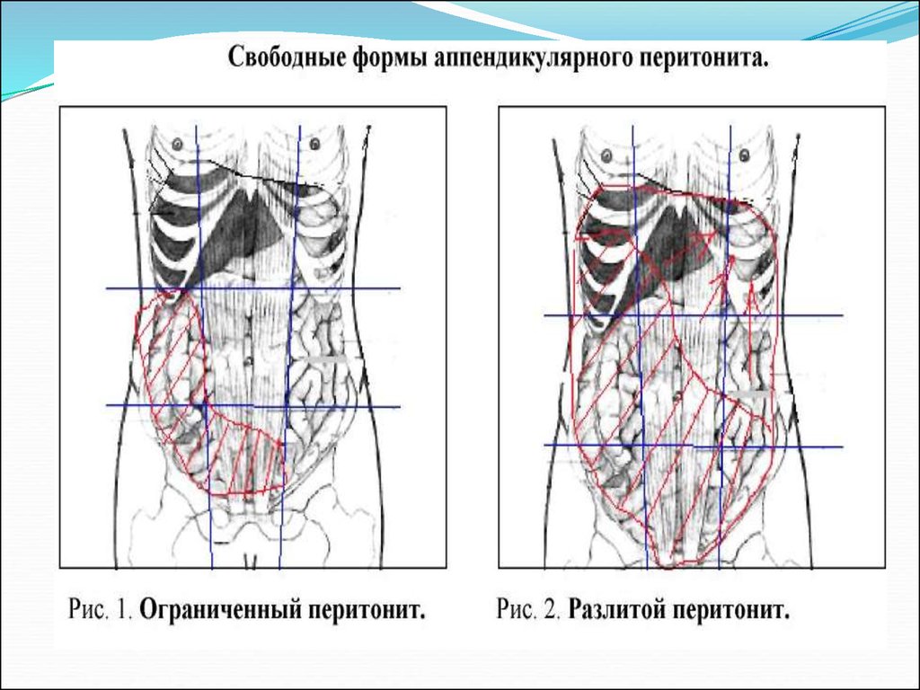 Перитонит у детей презентация