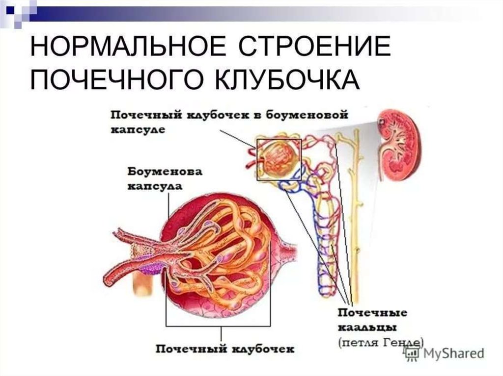 Нормальное строение. Гломерулонефрит почечный клубочек. Клубочек почки гломерулонефрит. Строение почки клубочки канальцы. Почки строение почечного клубочка.