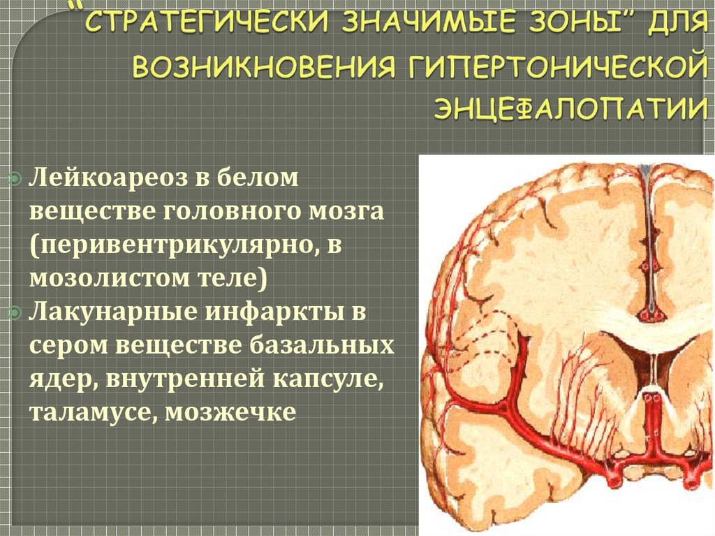 Зона ишемии. Ангиоэнцефалопатия головного мозга что это такое. Гипертоническая ангиоэнцефалопати. Зоны ишемии головного мозга. Энцефалопатия головного мозга что это такое.