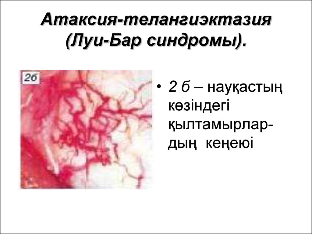 Атаксия-телангиэктазия (Луи-Бар синдромы).