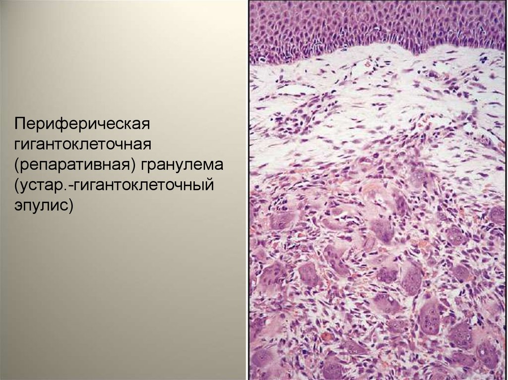 Клиническая картина периферической гигантоклеточной гранулемы характеризуется