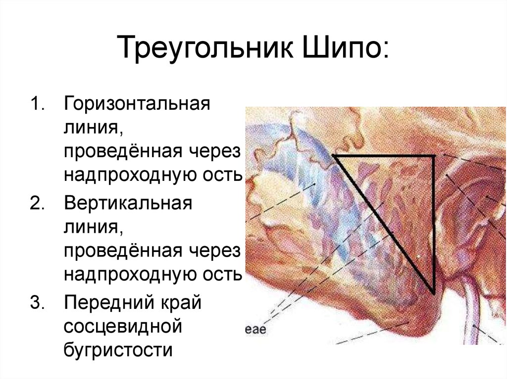 Треугольник кало топографическая анатомия. Область сосцевидного отростка и треугольника шипо. Треугольник шипо границы схема. Сосцевидный отросток топографическая анатомия. Трепанационный треугольник шипо.