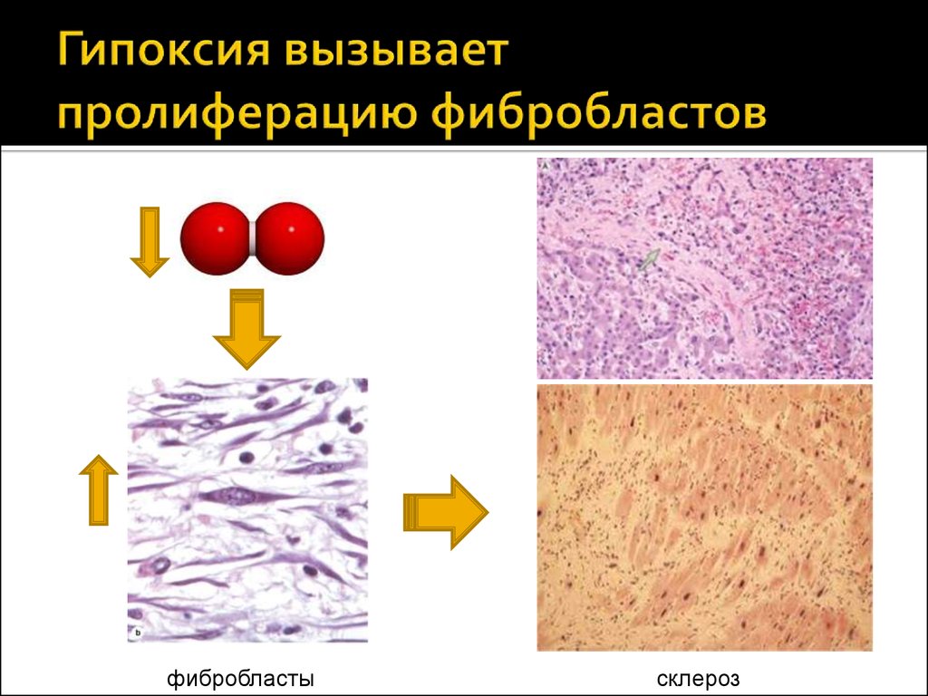 Гипоксия клеток. Пролиферация фибробластов гистология. Пролиферация соединительной ткани клетки. Фибробласты синтезируют коллаген. Активация фибробластов.