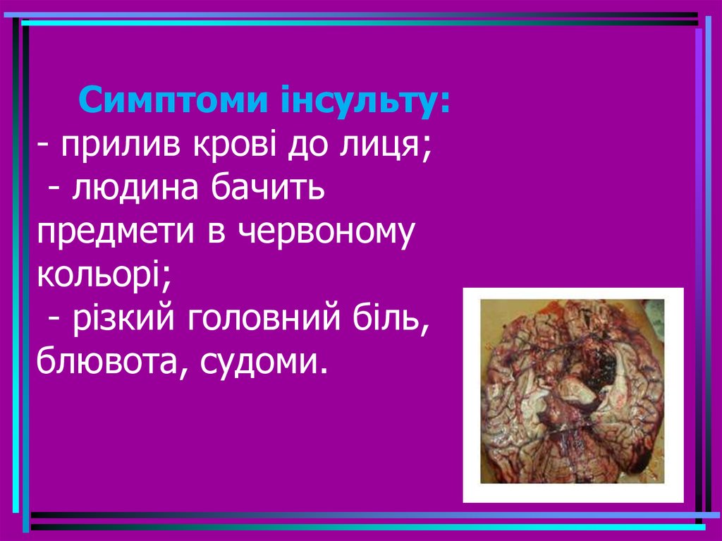 Симптоми інсульту: - прилив крові до лиця; - людина бачить предмети в червоному кольорі; - різкий головний біль, блювота,