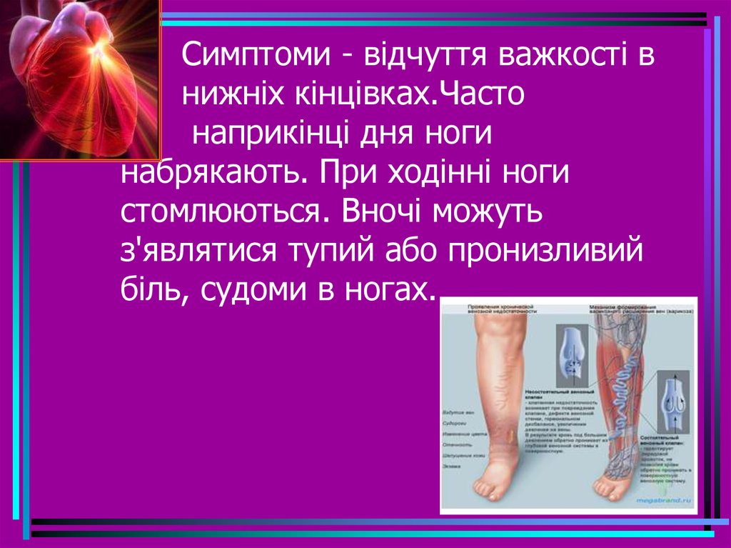 Симптоми - відчуття важкості в нижніх кінцівках.Часто наприкінці дня ноги набрякають. При ходінні ноги стомлюються. Вночі