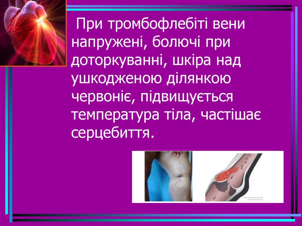 При тромбофлебіті вени напружені, болючі при доторкуванні, шкіра над ушкодженою ділянкою червоніє, підвищується температура