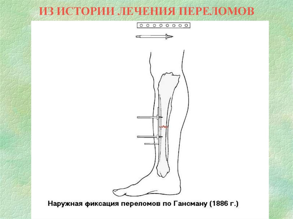 Карман риделя травматология рисунок