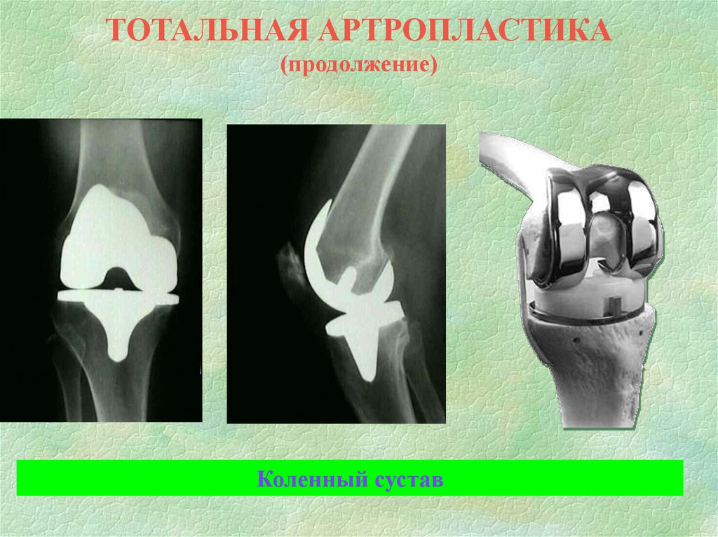 Артропластика сустава. Артропластика это эндопротезирование. Артропластика коленного сустава анатомия. Артропластика локтевого сустава.