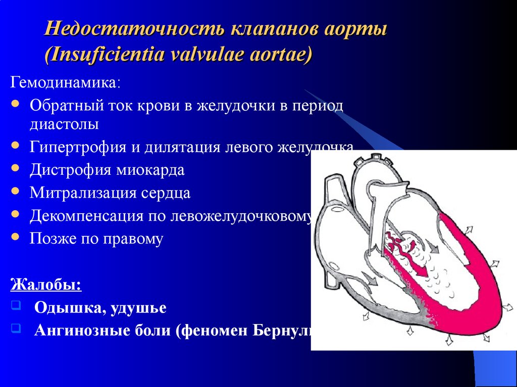 Поражение митрального клапана. Порок аортального клапана сердца. Аортальная недостаточность гемодинамика схема. Недостаточность клапана аорты гемодинамика. Недостаточность полулунного клапана аорты.