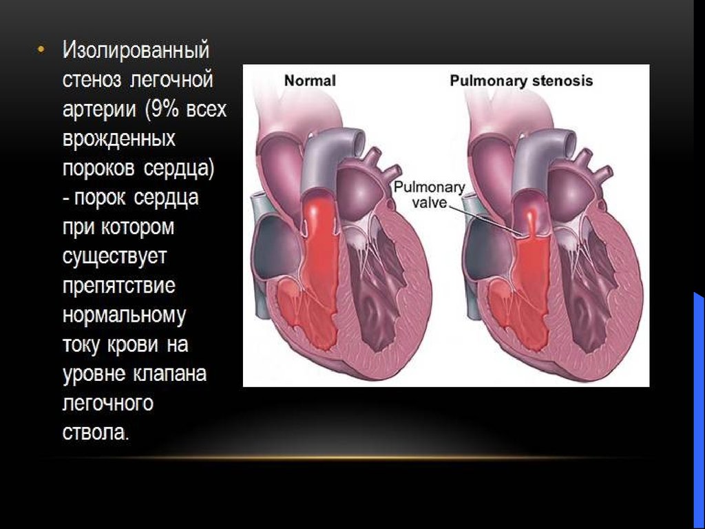 Сердечный стеноз. Сужение ствола легочной артерии. Пороки сердца стеноз легочной артерии у детей. Подклапанный стеноз легочной артерии. Стеноз клапана легочного ствола.