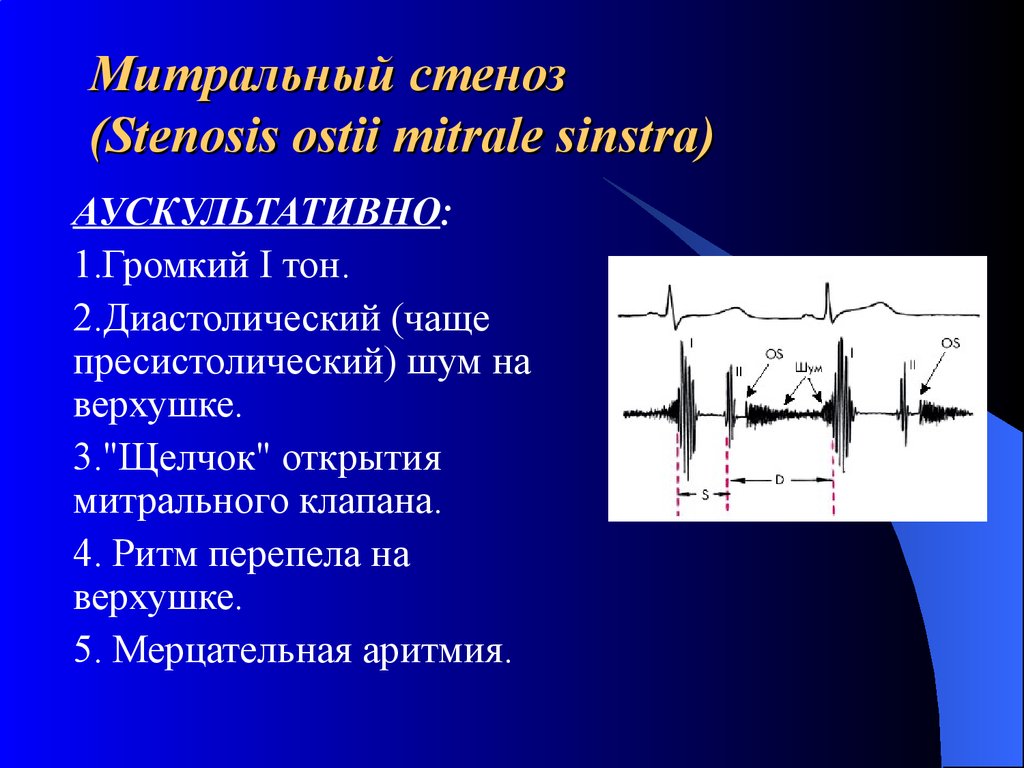 Митральный стеноз (Stenosis ostii mitrale sinstra)