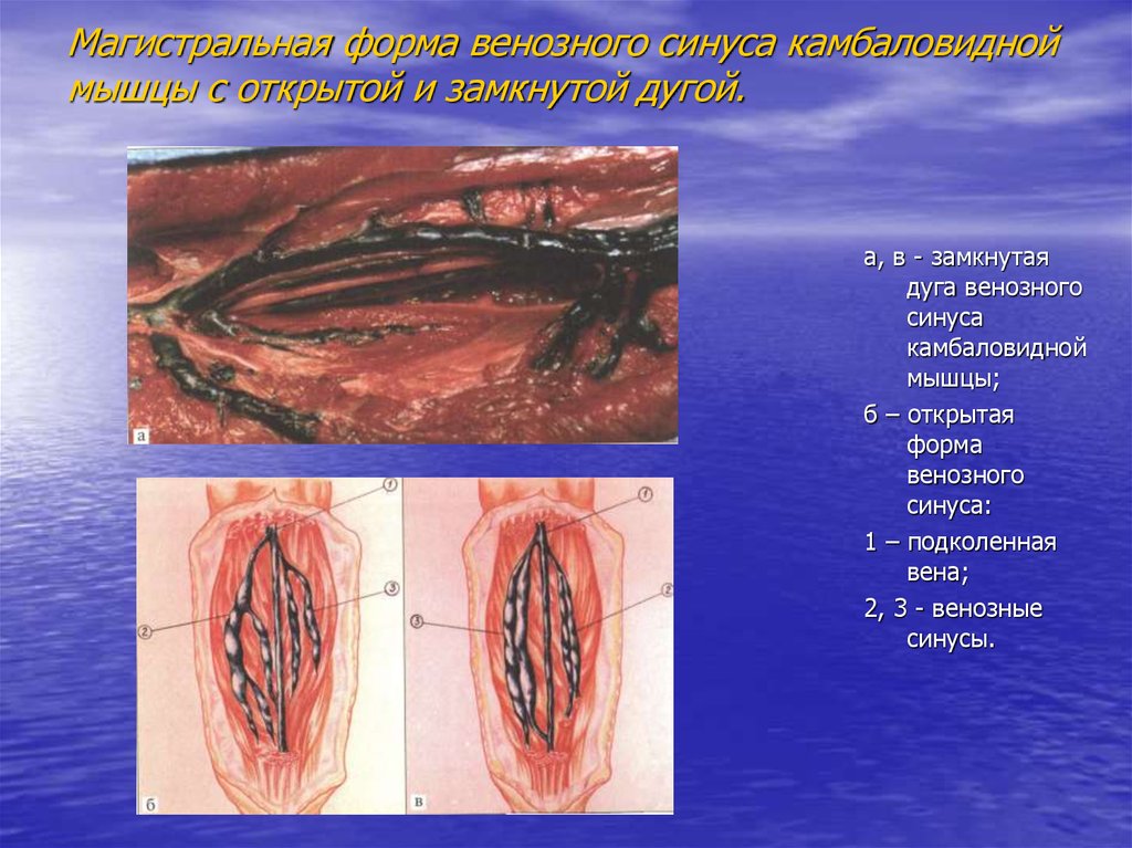 Мышцы вены. Вены синус камбаловидной мышцы. Вены мышечно венозного синуса. Венозный синус камбаловидной мышцы. Синусы икроножные венозные.