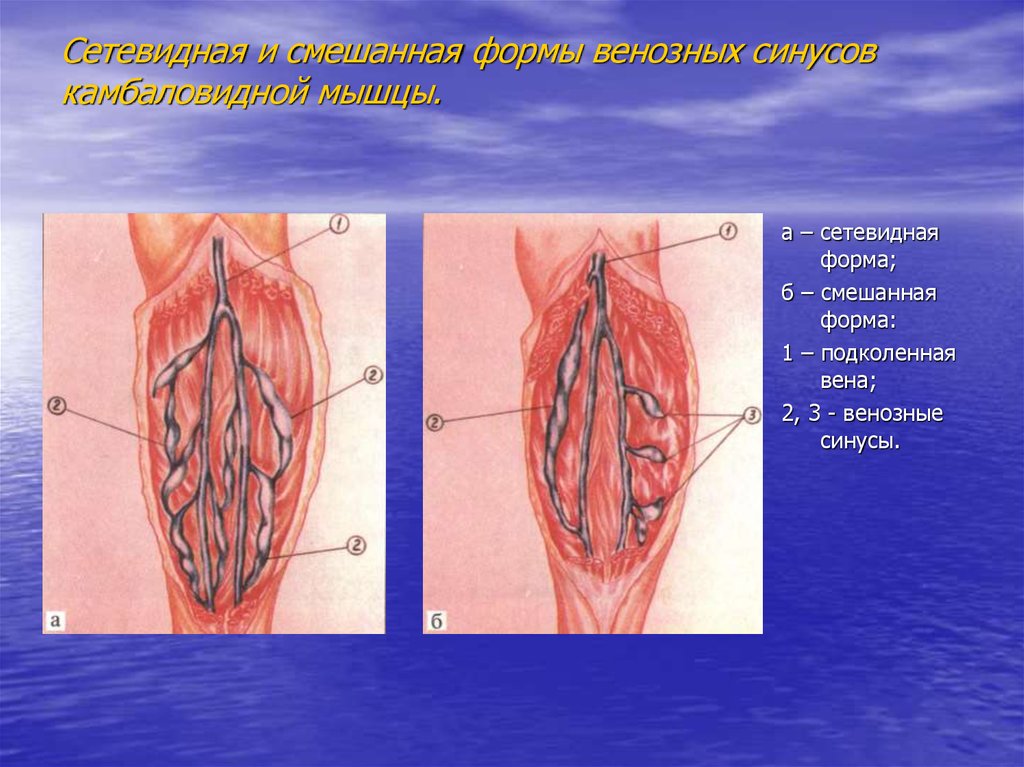 Мышцы вены. Вены синус камбаловидной мышцы. Вены мышечно венозного синуса. Венозный синус камбаловидной мышцы. Анатомия венозных синусов камбаловидной мышцы.