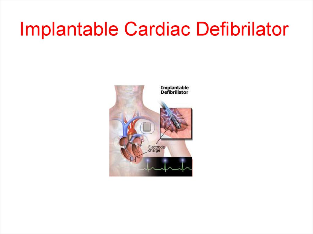 Pacemakers And Implantable Defibrillators Online Presentation