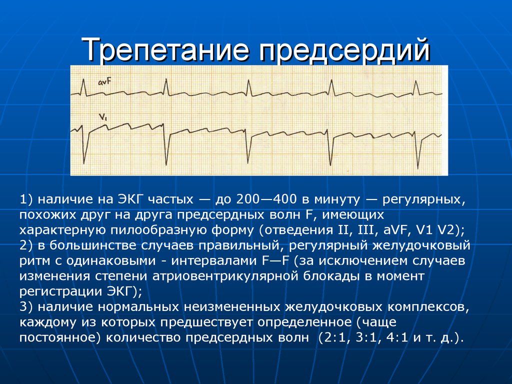 Что такое фибрилляция предсердий. Диагноз: трепетание предсердий ЭКГ. Трепетание и фибрилляция предсердий на ЭКГ. Трепетание предсердий на ЭКГ волны f. Трепетание предсердий 1 к 1 на ЭКГ.