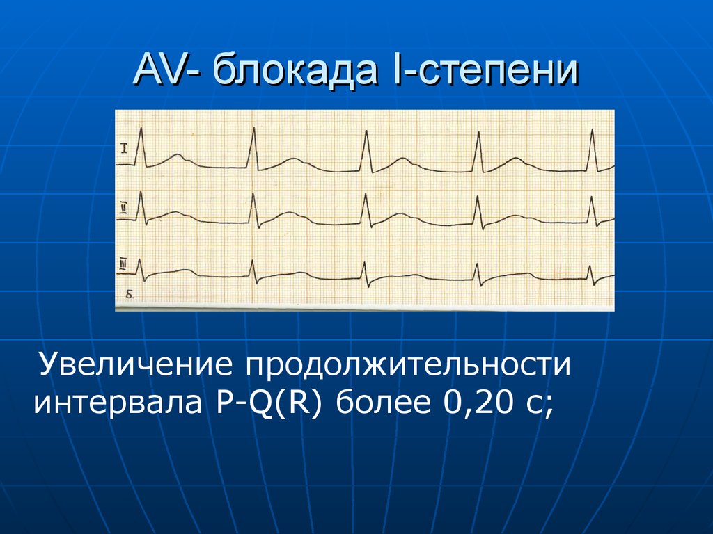 Ав блокада 1 степени. АВ блокада 1 степени на ЭКГ. Аб блокада 1 степени на ЭКГ. Атриовентрикулярная блокада 1 степени на ЭКГ. Интервал PQ при АВ блокаде 1 степени.