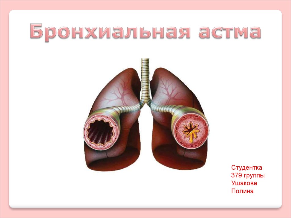 Презентация бронхиальная астма дипломная работа