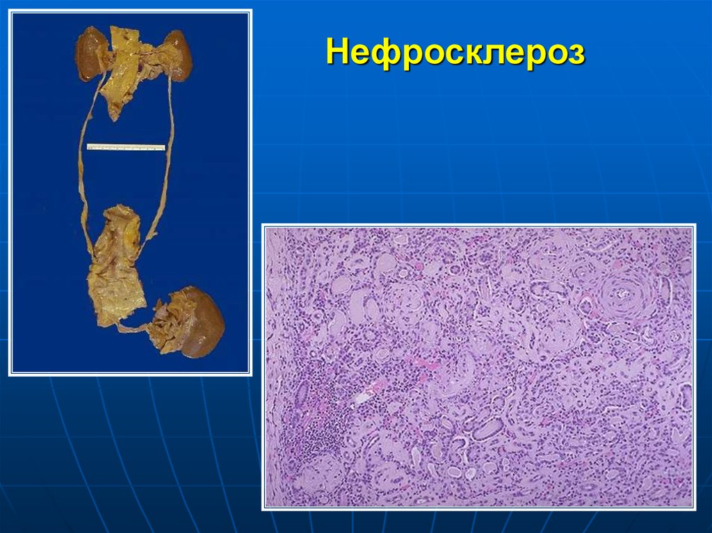 Артериолосклеротический нефросклероз микропрепарат рисунок