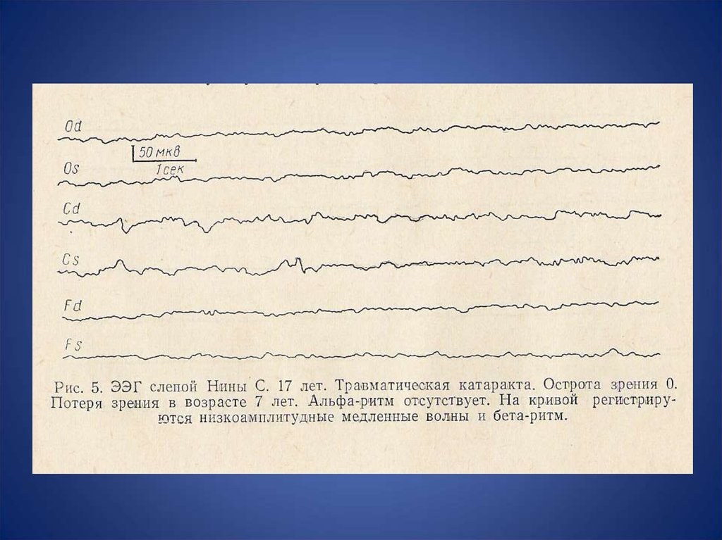 МКВ волны ЭЭГ. Альфа ритм на ЭЭГ У детей норма и нарушения. ЭЭГ при аутизме. Зрительные нарушения на ЭЭГ.