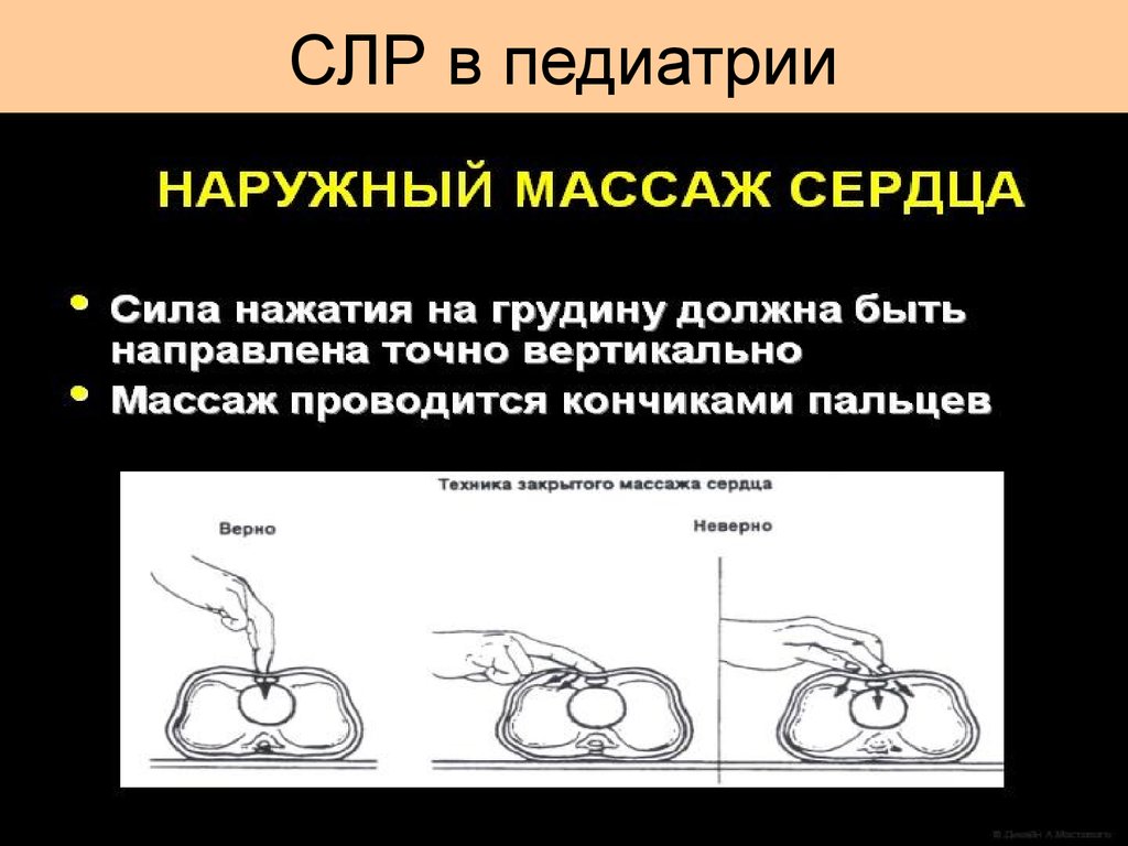 Слр новорожденных презентация