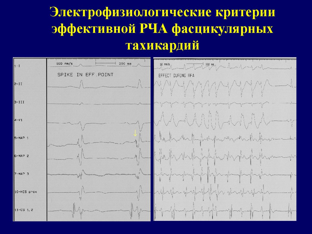 Пульс после рча