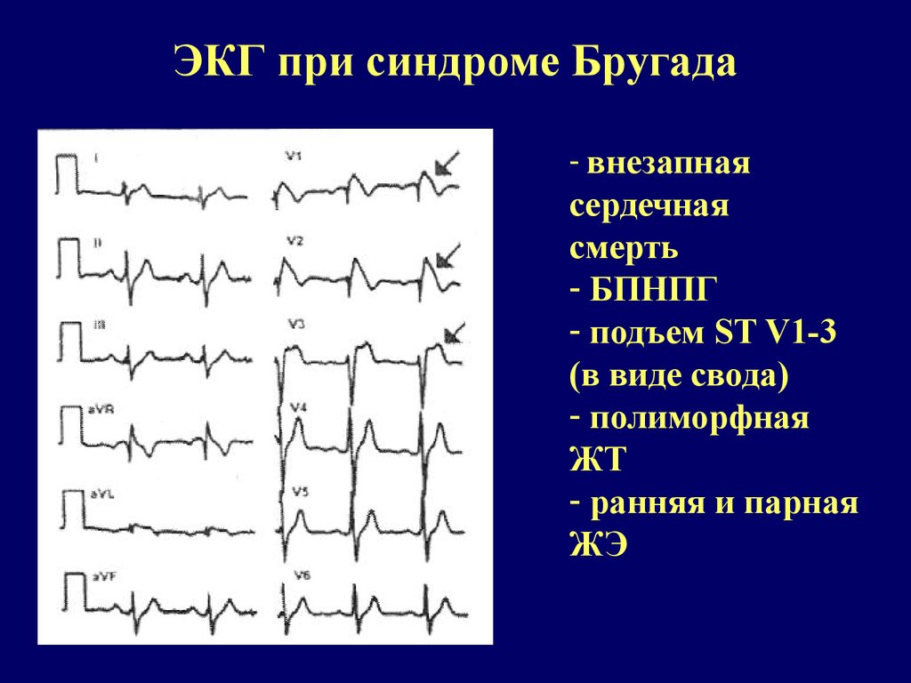 Синдром бругада на экг фото