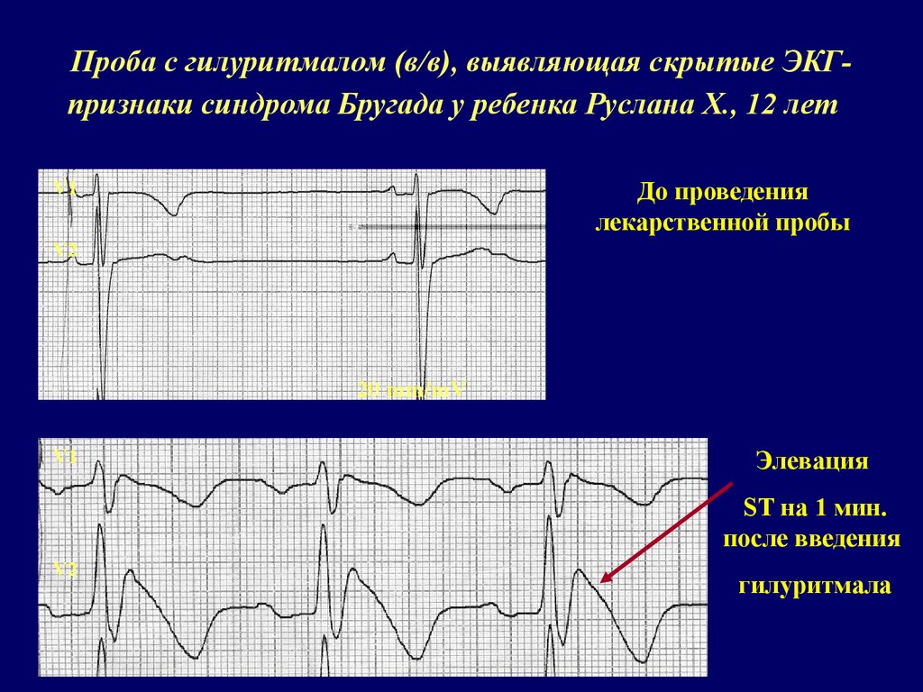 Экг синдромы. Синдром Бругада на ЭКГ. Синдром Бругада 1 Тип на ЭКГ. Синдром Бругада ЭКГ признаки. Синдром Бругада Тип 2 ЭКГ.