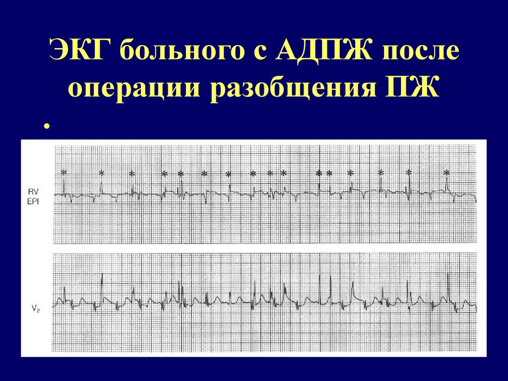 Экг пациентов. ЭКГ больного. ЭКГ при АДПЖ. Правожелудочковая дисплазия. Волна Эпсилон при АДПЖ.