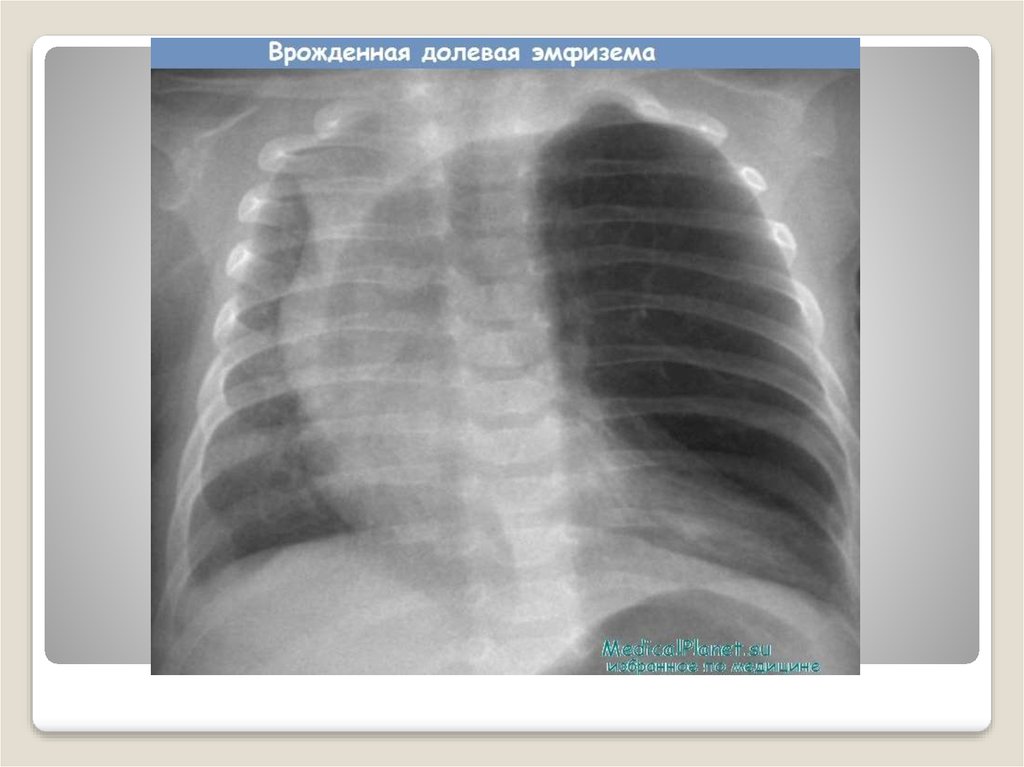 Врожденная лобарная эмфизема клиника рентгенологическая картина принципы лечения