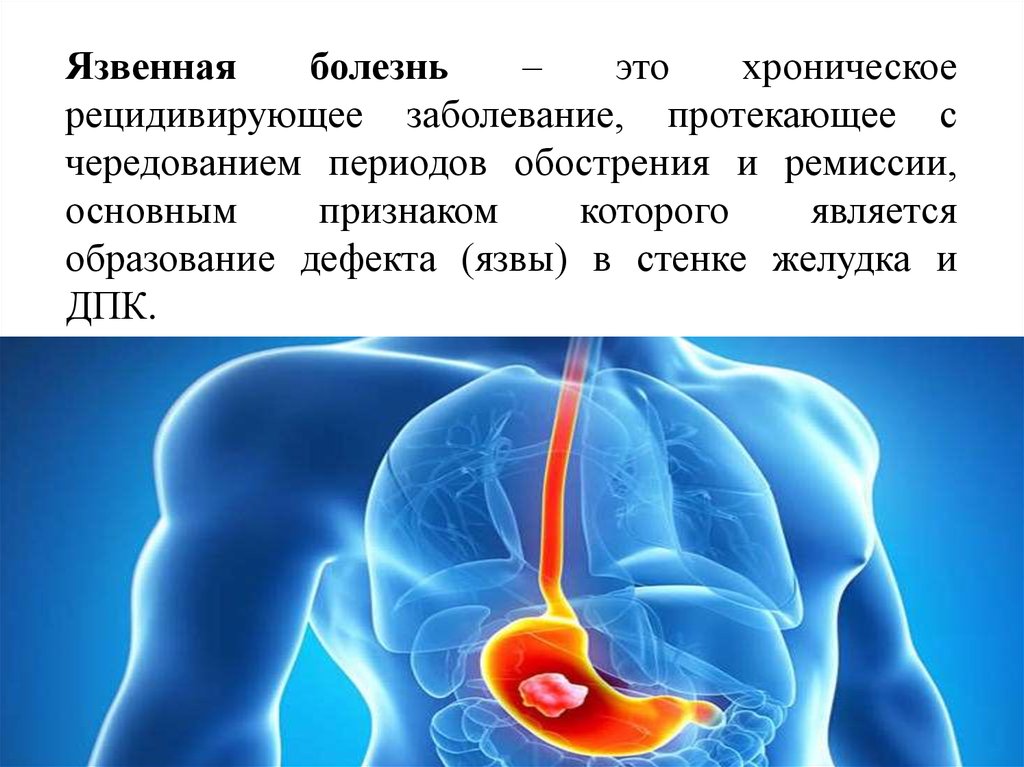 Болезнь это. Язвенная болезнь хроническое рецидивирующее заболевание. Ремиссия язвенной болезни. Ведущим симптомом обострения язвенной болезни являются боли в.