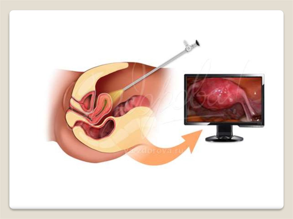Гироскопия гинекология