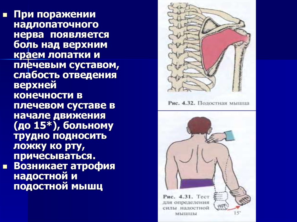 Парез дюшена эрба это