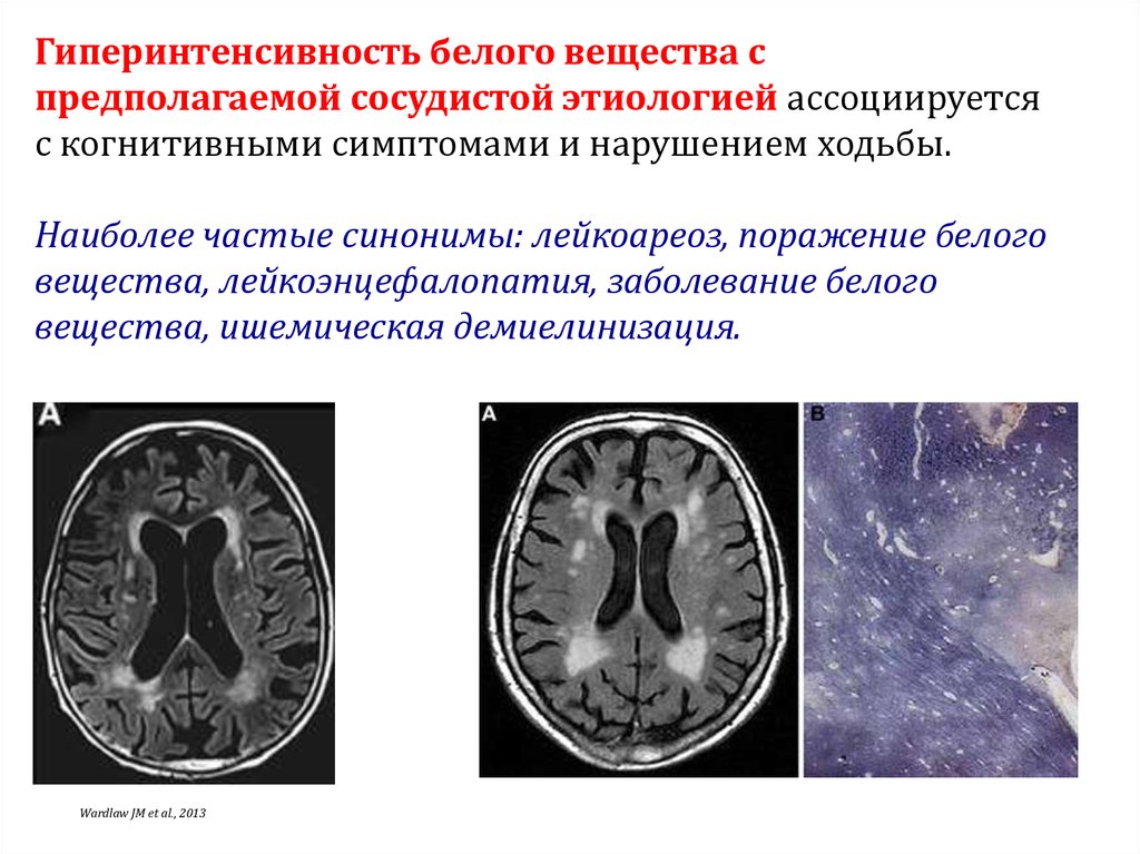 Микроангиопатия головного мозга fazekas. Дисциркуляторная энцефалопатия кт мрт. Лейкоареоз головного мозга на кт. Кт картина дисциркуляторной энцефалопатии. Дисциркуляторная энцефалопатия патогенез.