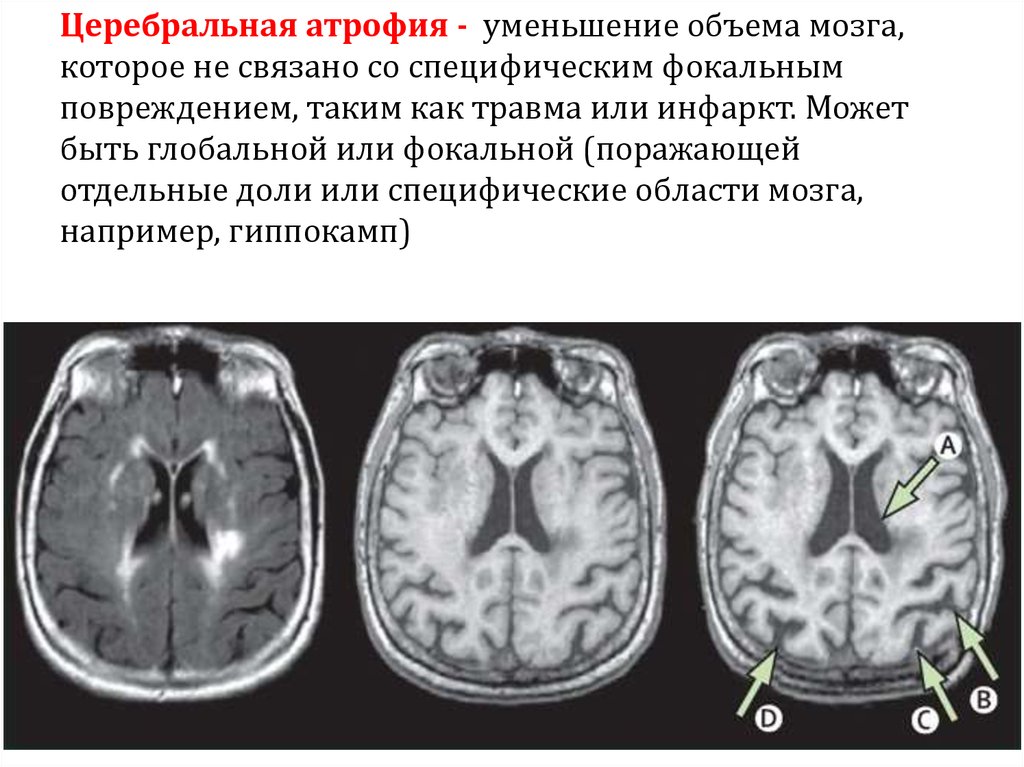 Атрофия головного мозга 1