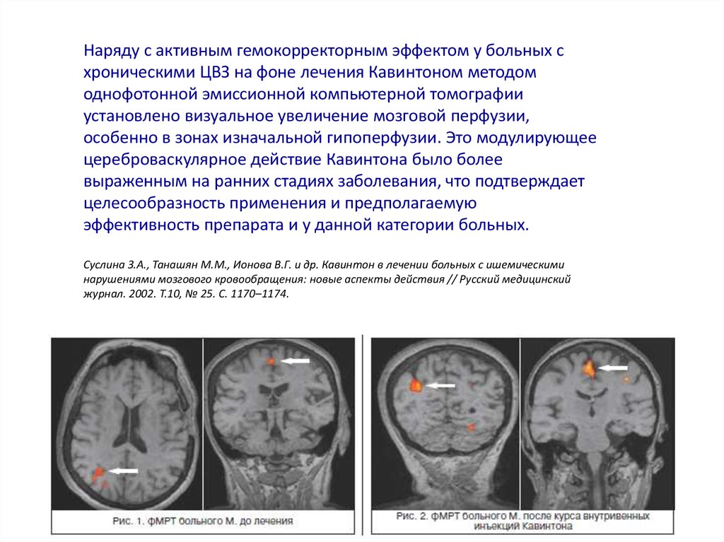 Лечение изменения мозга. Дисциркуляторная энцефалопатия на кт. Дисциркуляторная энцефалопатия головного мозга на кт. Стадии энцефалопатии головного мозга кт. Дисциркуляторная энцефалопатия на мрт заключение.