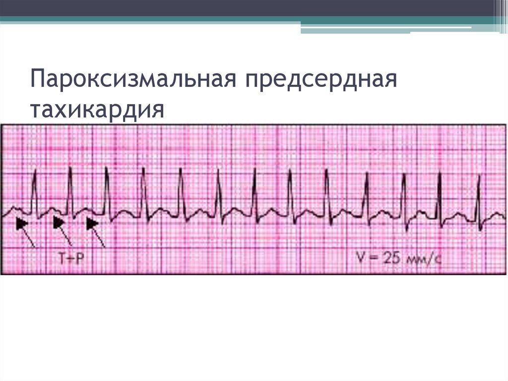 Признаки тахикардии на экг. Предсердная пароксизмальная тахикардия на ЭКГ. ЭКГ-критерии пароксизмальной предсердной тахикардии. Суправентрикулярная тахикардия ЭКГ. Суправентрикулярная пароксизмальная тахикардия на ЭКГ.
