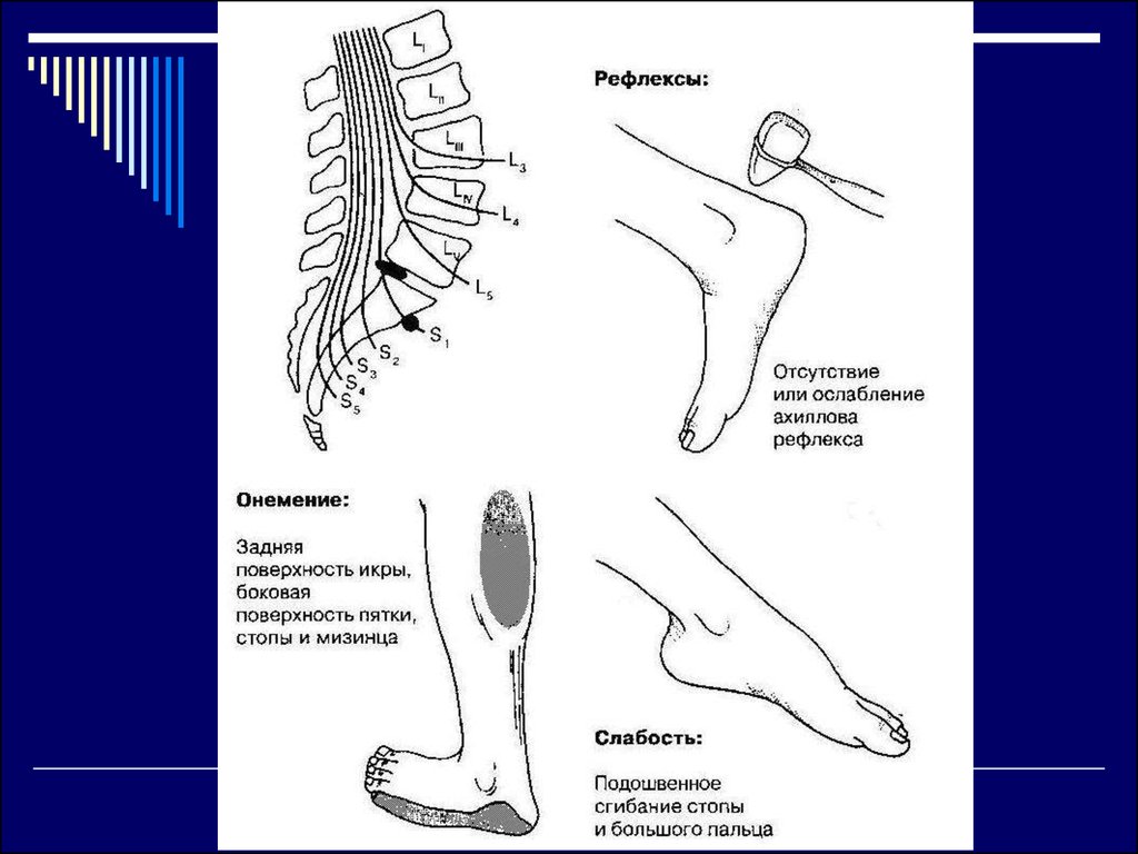 Неврологические боли в ногах. Отсутствие ахиллова рефлекса. Онемела тыльная поверхность стопы. Неврологические синдромы шейного остеохондроза.