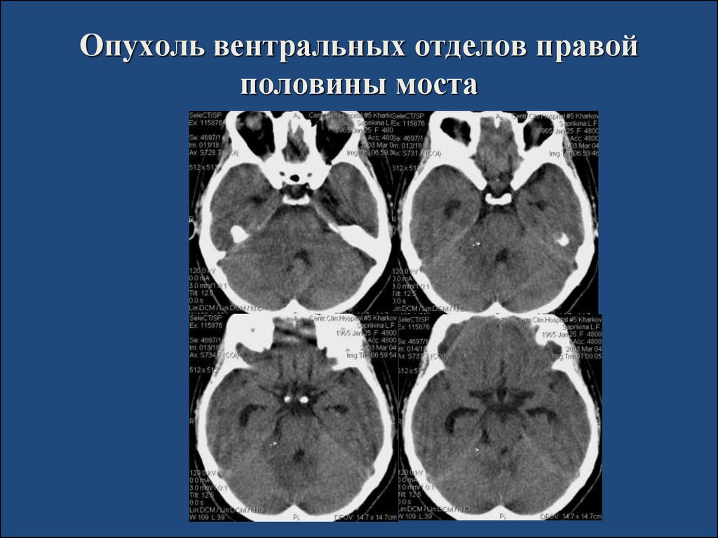 Правая половина. Опухоль моста головного мозга. Опухоль моста головного мозга кт. Диффузная опухоль моста. Опухоль среднего мозга.