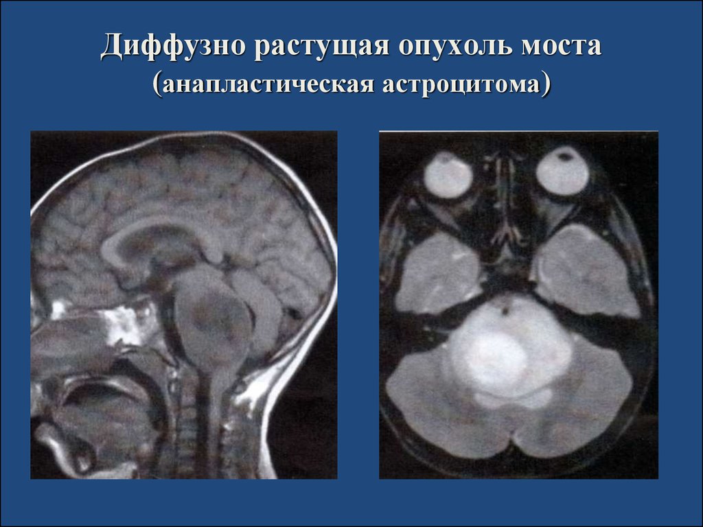 Диффузная астроцитома. Диффузная глиома ствола головного. Астроцитома головного мозга в стволе. Глиома ствола головного мозга.